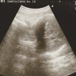 妊娠32週目のエコー画像