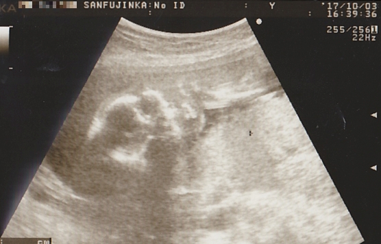 妊娠20週（6か月）のエコー写真