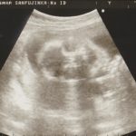 妊娠24週・頭部のエコー画像