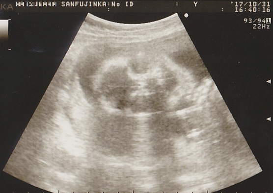 妊娠24週・頭部のエコー画像