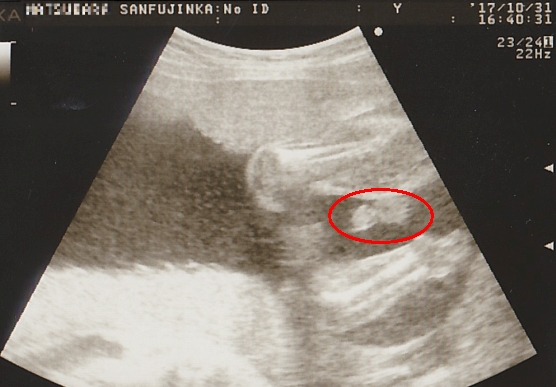 妊娠24週（7か月）のエコー画像・下から見た図