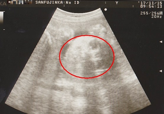 妊娠26週（7ヶ月）のエコー写真