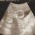 妊娠16週のエコー写真