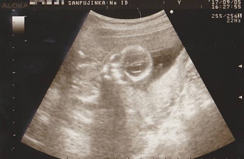 妊娠16週のエコー写真