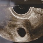 妊娠6週0日のエコー写真