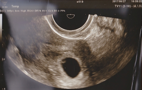 妊娠6週0日のエコー写真
