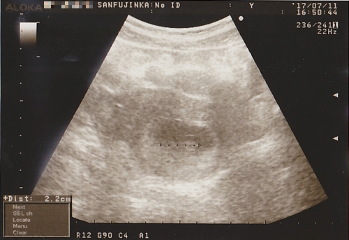 妊娠8週1日のエコー写真