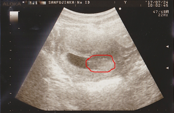 妊娠10週0日のエコー写真