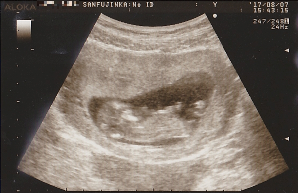 妊娠12週1日のエコー画像